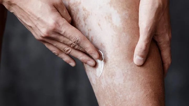 哈尔滨白癜风医院:白癜风手拉手传染不