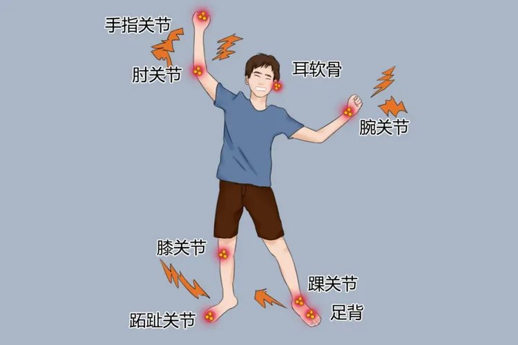 痛风发病部位
