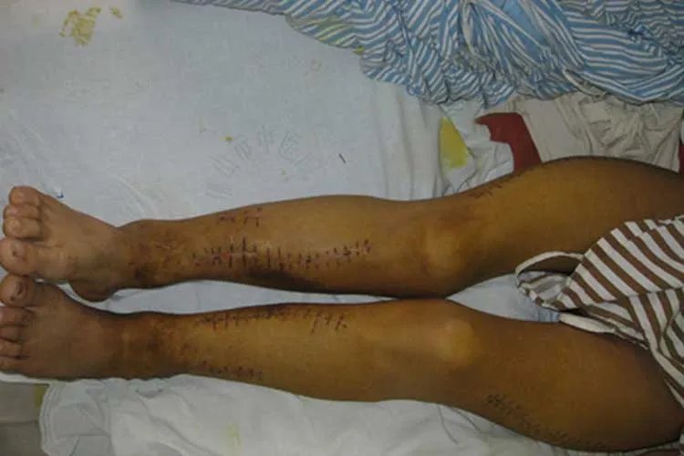 小宝宝佝偻病症状图片