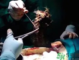 女孩偷吃头发5年 吃头发是什么病?