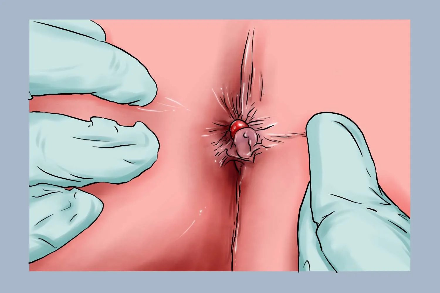 痔疮图片和正常图片