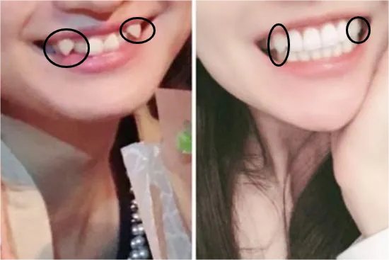 虎牙矫正前后对比照片