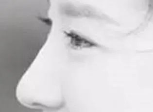 把鼻子整小需要多少钱