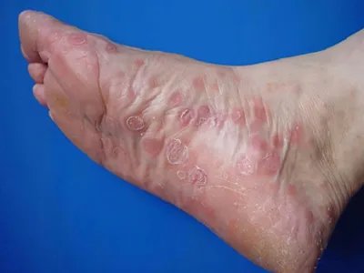 战壕热症状图片