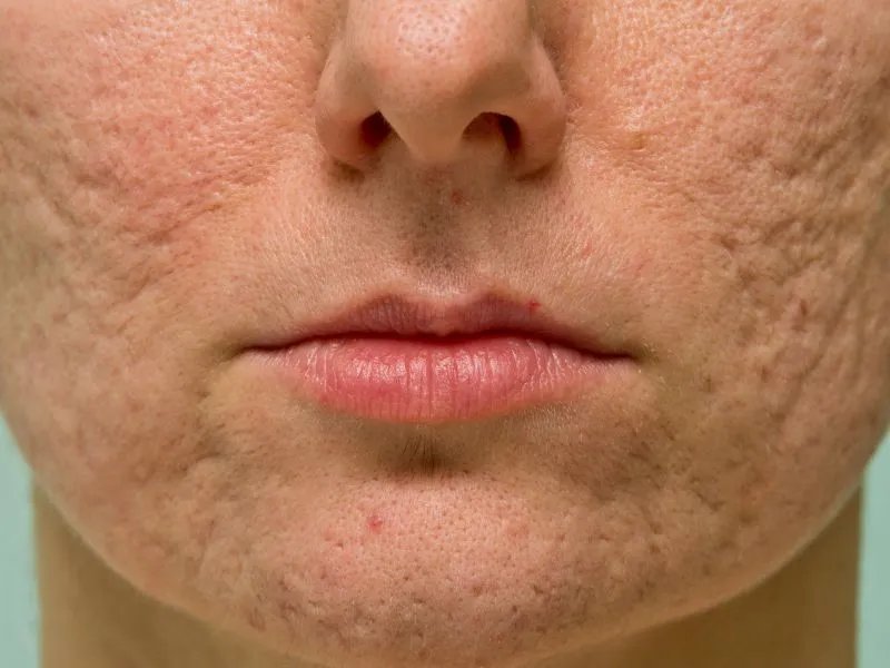 中医去粉刺的方法