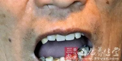 街头补牙只要30元 补牙材料有哪些讲究