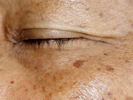 该怎么减少色斑