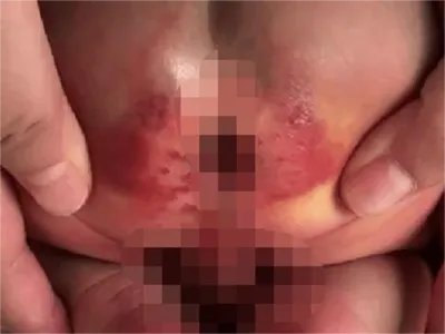 外阴蛲虫病症状图片