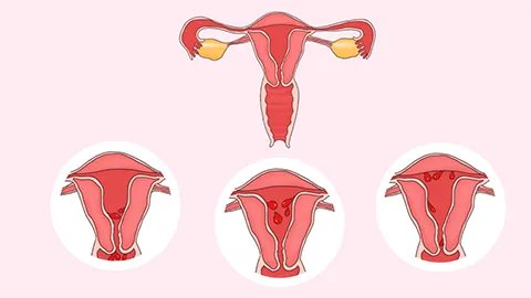 婴儿胚胎被冷冻还可以移植入子宫吗