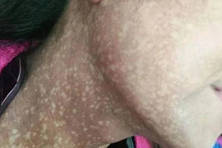 瑞尔黑变病斑图片