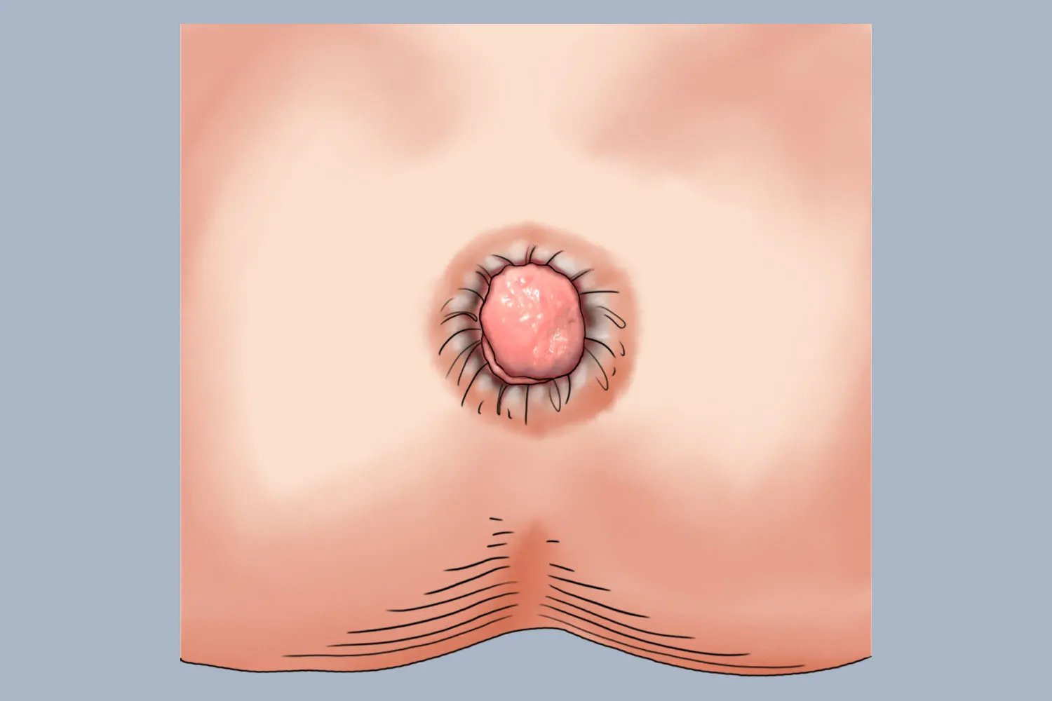 痔疮是什么形状的照片