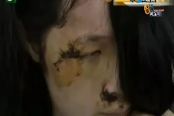 女子被骑手撞毁容具体情况是怎样的？