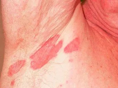 间擦疹腋窝红斑图片