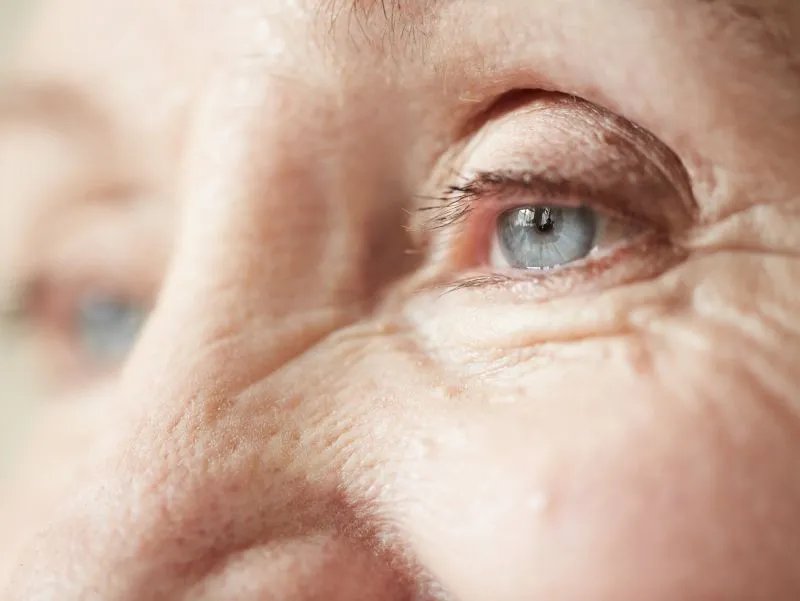 怎样消除眼角细纹