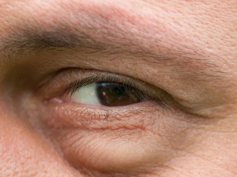 煮鸡蛋去眼袋有效吗