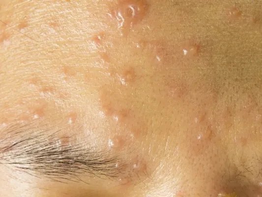 额头上长白色小疙瘩是怎么回事