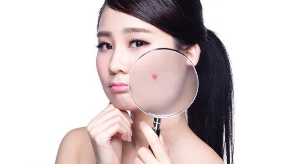 激光祛痘手术后患者应当注意什么
