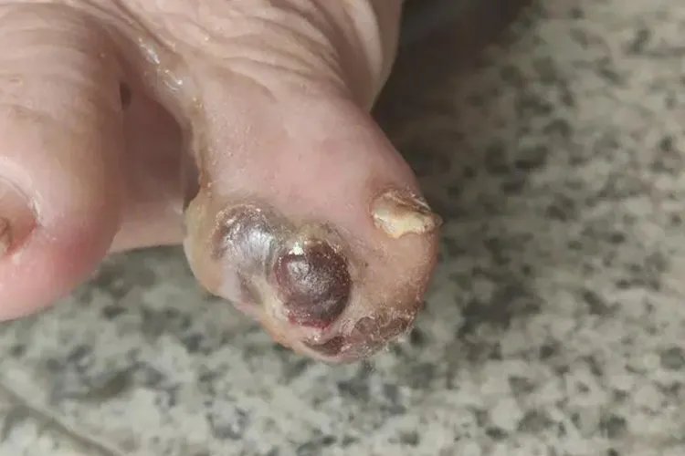小脚趾黑色素瘤图片