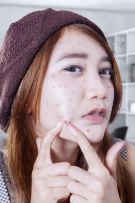 痤疮疤痕该怎么治疗比较好