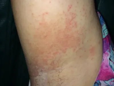 间擦疹腋窝红斑图片
