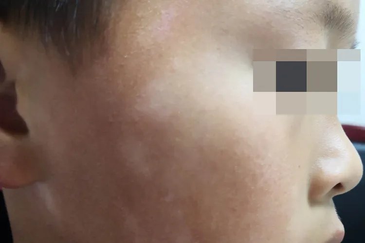 白斑初期症状图片是什么样