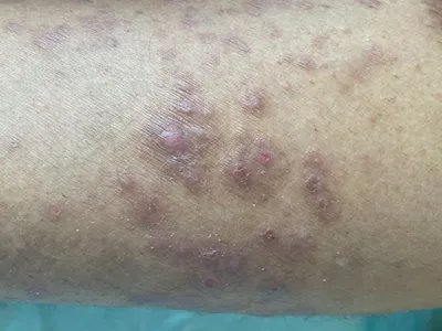 慢性湿疹小腿症状图片