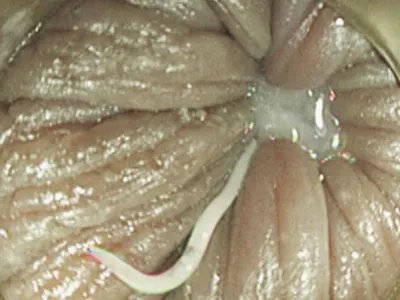 外阴蛲虫病症状图片