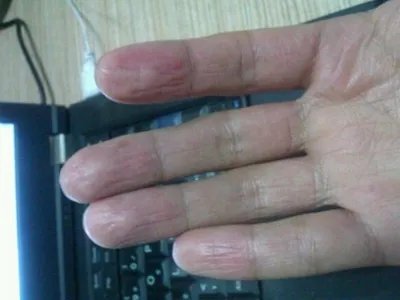 进行性指掌角皮症竖纹图片