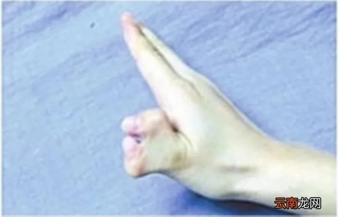 拉手幸福女孩，多指多福女孩切除多指牵住幸福