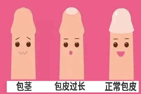 包皮过长的图片