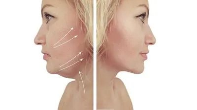 注射除皱需要多少钱 注射除皱的收费情况细说