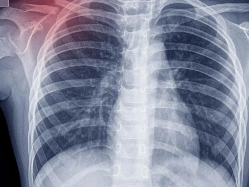 肺鳞癌中期平均生存期