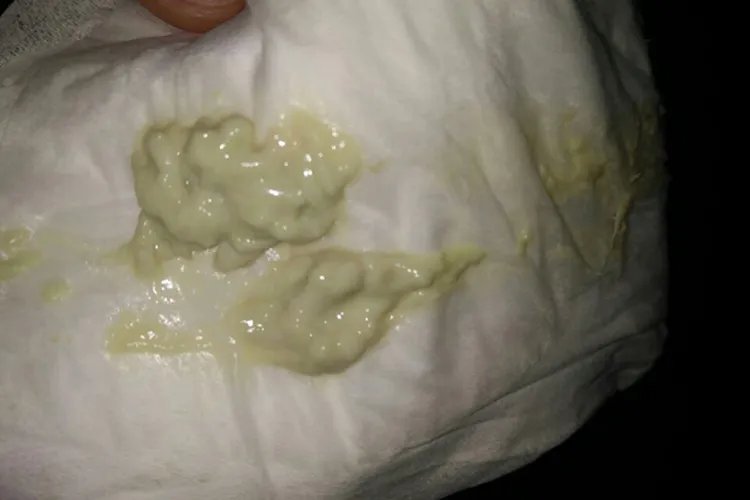 霉菌性阴炎图片