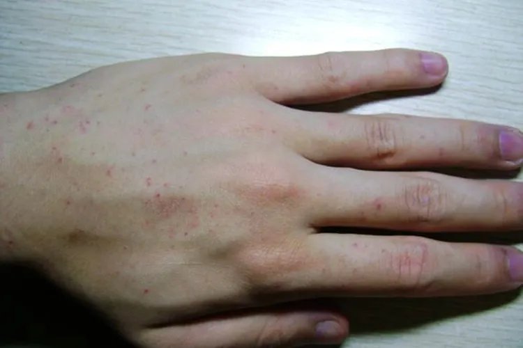 手上突然冒出紫色点点图片