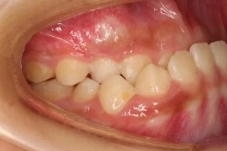 需要矫正的牙齿类型图片