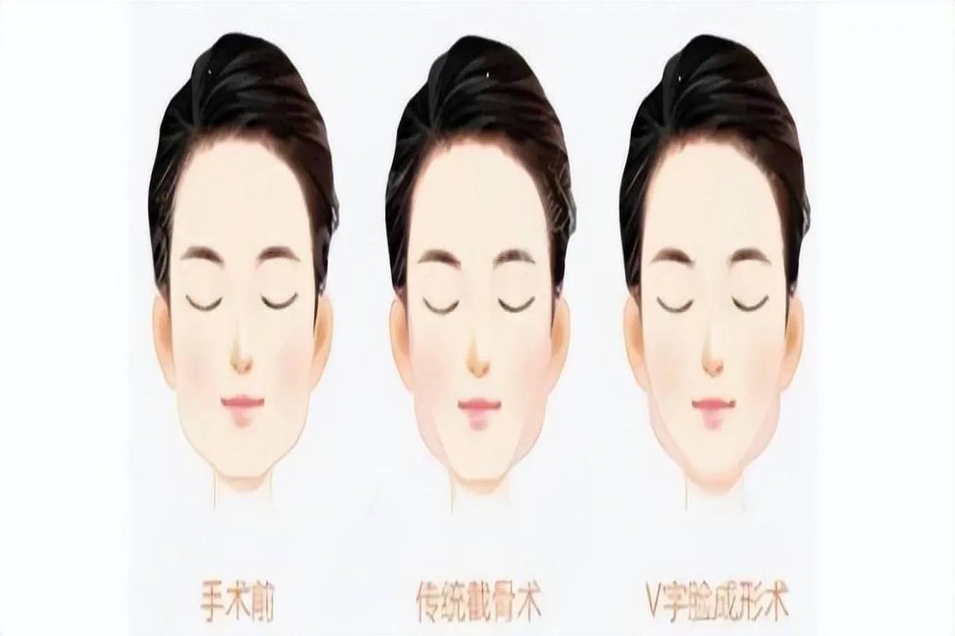 削骨瘦脸图片对比