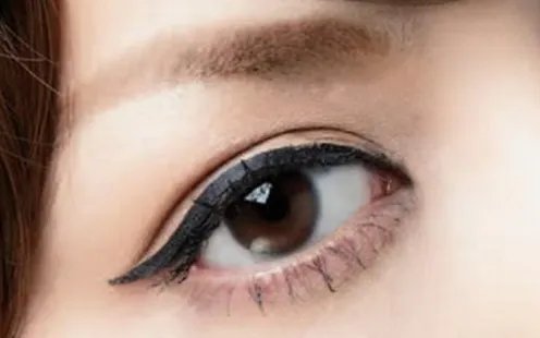 北京割双眼皮价钱