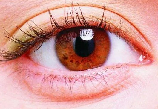 做双眼皮开眼角多少钱