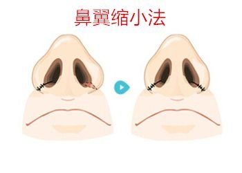 缩小鼻翼的方法有哪几种呢？