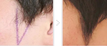 鬓角移植多久恢复