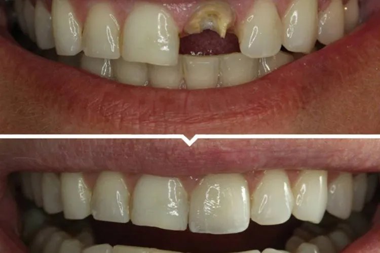 烤瓷牙前后对比照图片