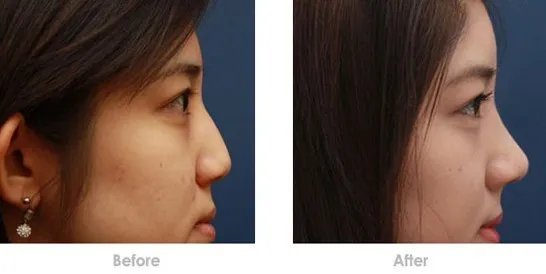 鼻梁骨整形的注意事项