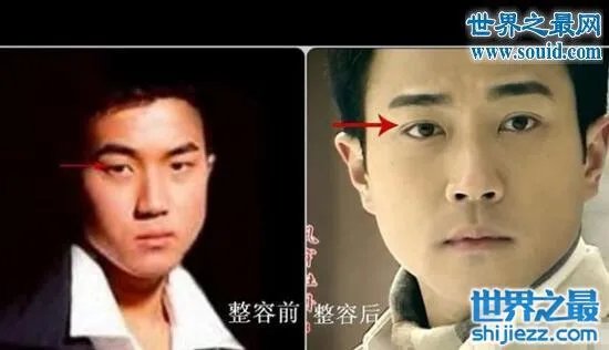 刘恺威整容前后照片曝光，五官全整简直大换脸 