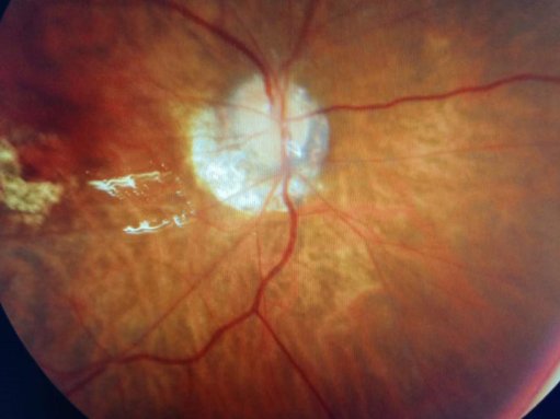 眼球摘除术治疗视网膜母细胞瘤