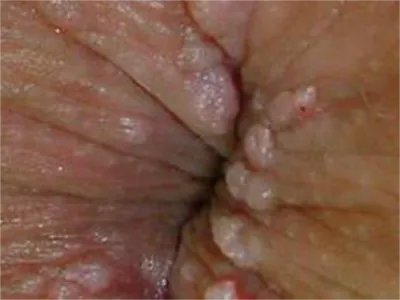 外阴蛲虫病症状图片