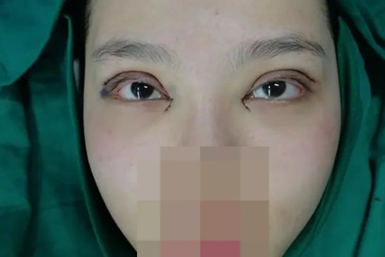 双眼皮开内眼角图片