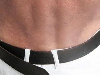 焦油黑变病腰部斑图片