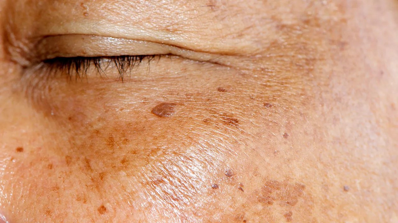 老年斑怎样去掉