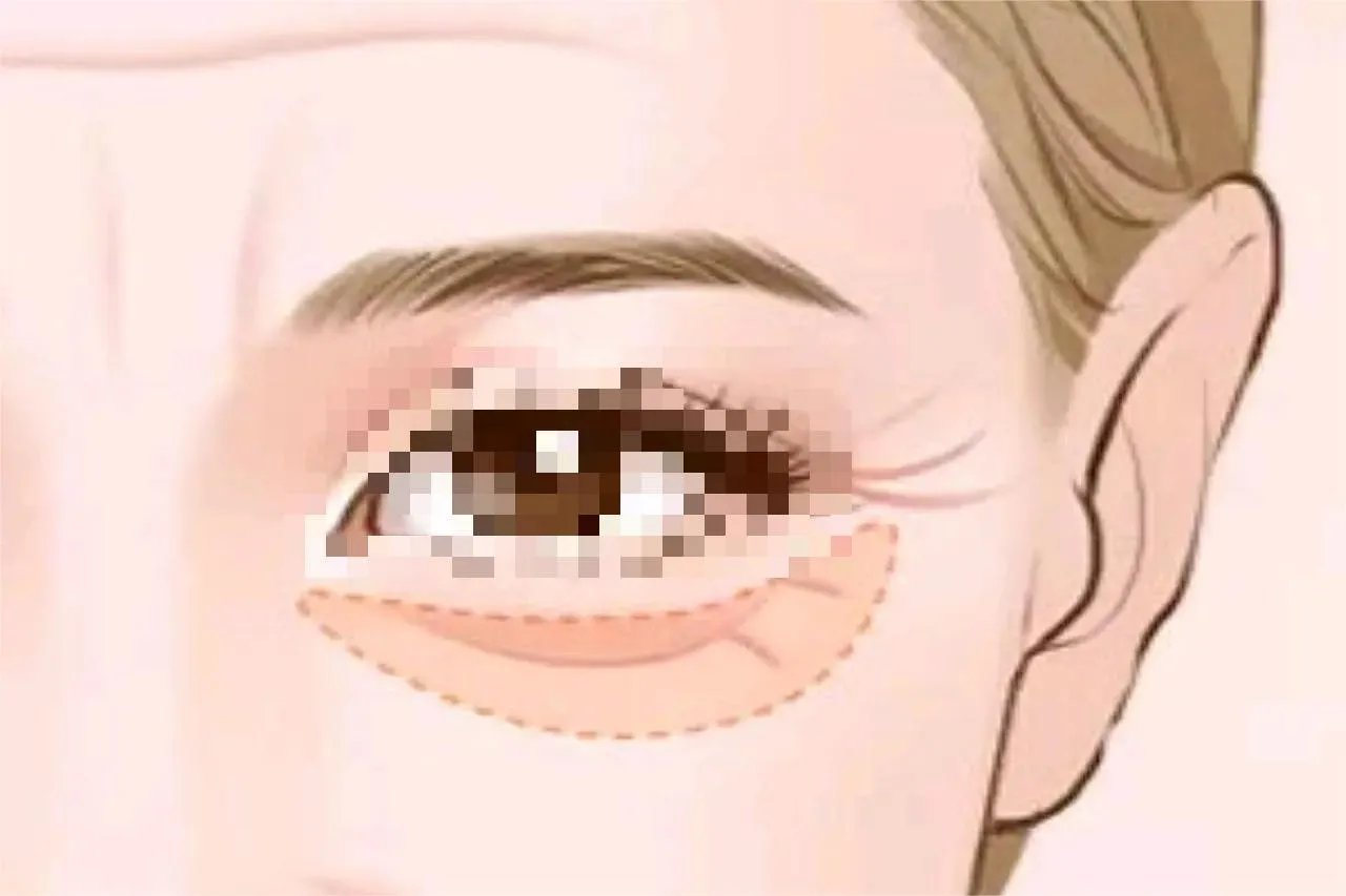 外切眼袋手术切口位置图片