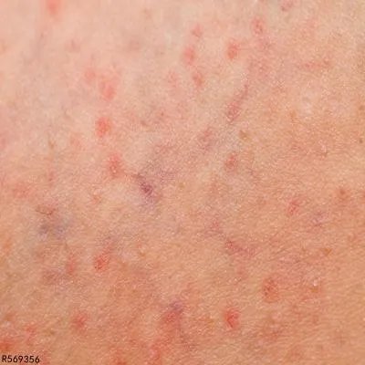 秋季皮肤过敏怎么办 教你四招缓解皮肤过敏症状